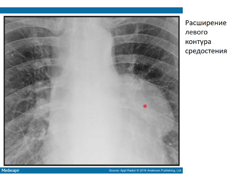 Расширение левого контура средостения